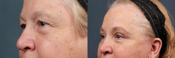 Eyelid Surgery Case 584 Before & After View #2 | Louisville, KY | CaloSpa® Rejuvenation Center