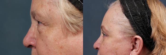 Eyelid Surgery Case 584 Before & After View #3 | Louisville, KY | CaloSpa® Rejuvenation Center