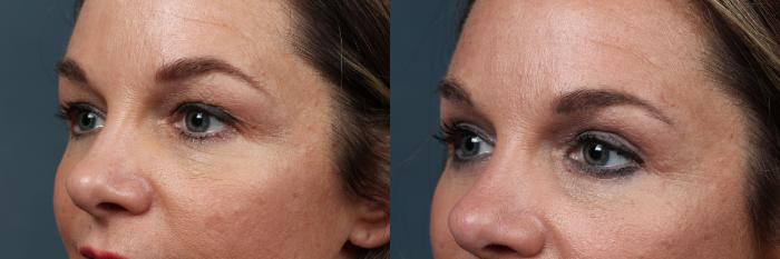 Eyelid Surgery Case 585 Before & After View #2 | Louisville, KY | CaloSpa® Rejuvenation Center