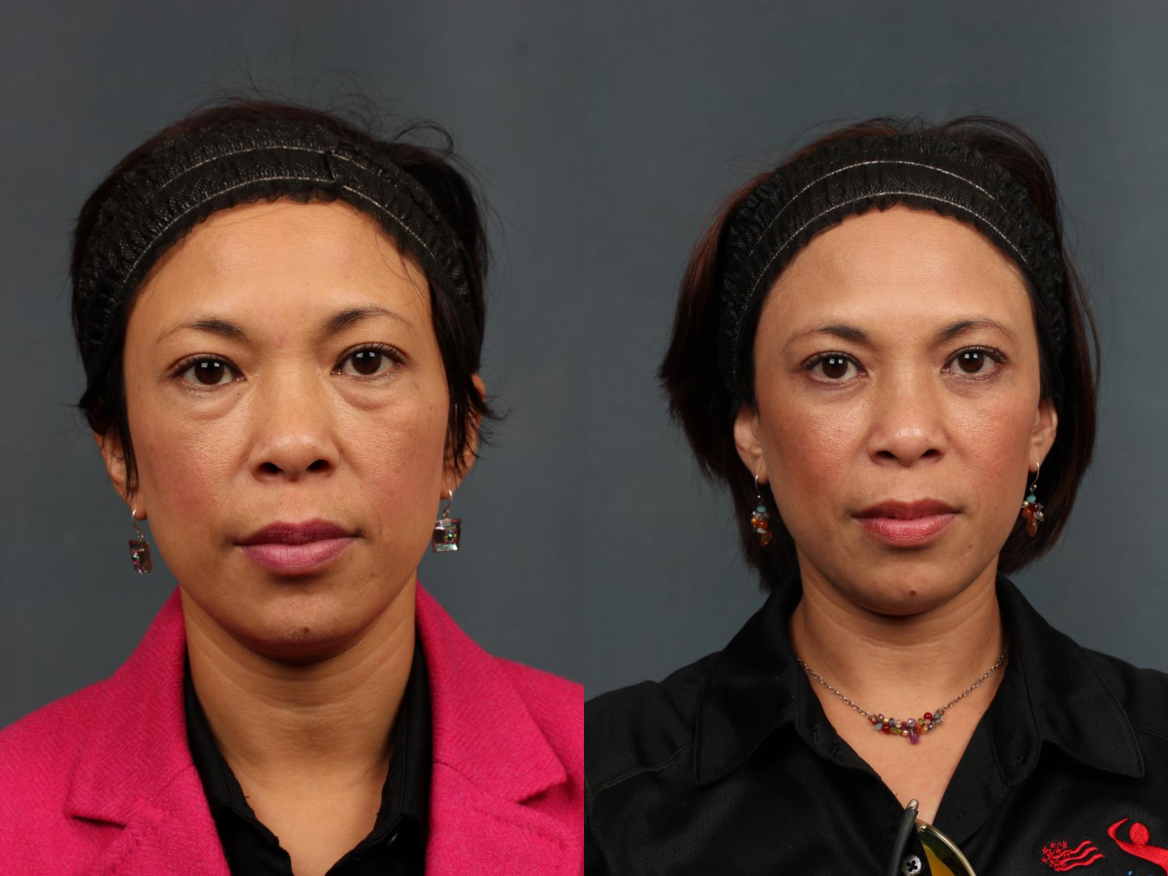 Before & After Eyelid Surgery Case 603 View #1 View in Louisville & Lexington, KY