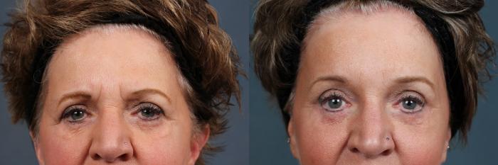 Eyelid Surgery Case 605 Before & After View #1 | Louisville, KY | CaloSpa® Rejuvenation Center