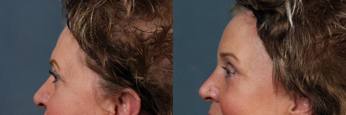 Eyelid Surgery Case 605 Before & After View #2 | Louisville, KY | CaloSpa® Rejuvenation Center
