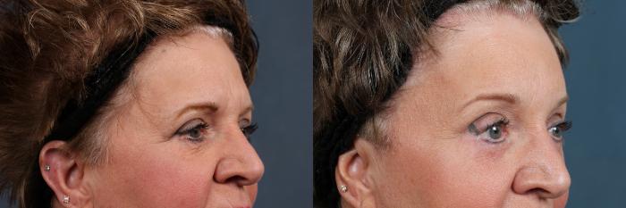 Before & After Eyelid Surgery Case 605 View #3 View in Louisville & Lexington, KY