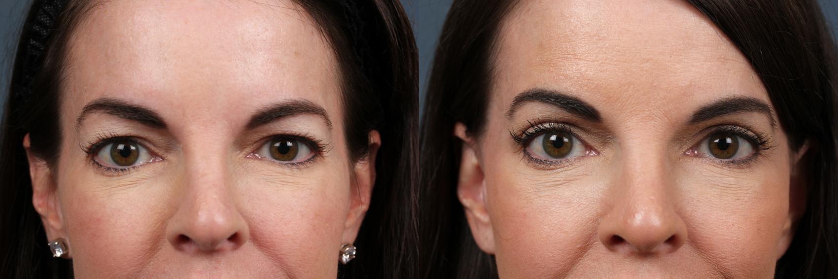 Before & After Eyelid Surgery Case 606 View #1 View in Louisville, KY