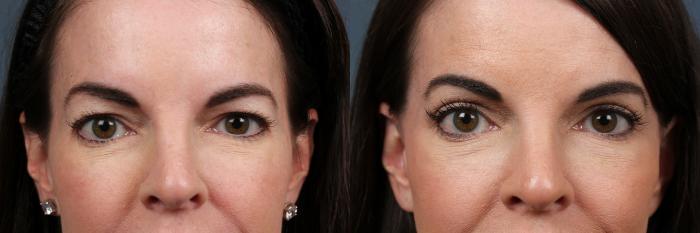 Eyelid Surgery Case 606 Before & After View #1 | Louisville, KY | CaloSpa® Rejuvenation Center