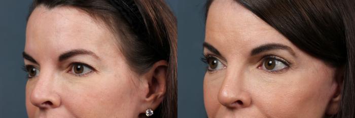 Eyelid Surgery Case 606 Before & After View #2 | Louisville, KY | CaloSpa® Rejuvenation Center