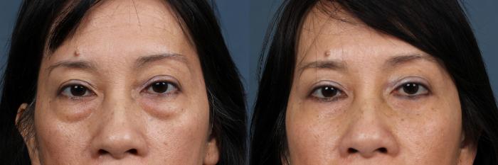 Eyelid Surgery Case 607 Before & After View #1 | Louisville, KY | CaloSpa® Rejuvenation Center