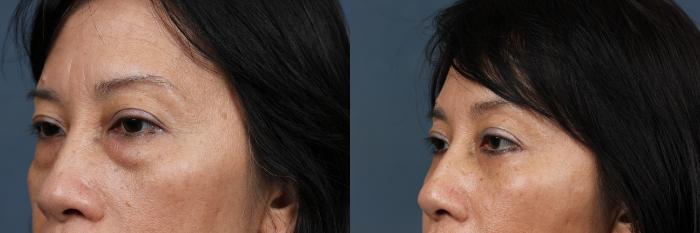 Eyelid Surgery Case 607 Before & After View #2 | Louisville, KY | CaloSpa® Rejuvenation Center
