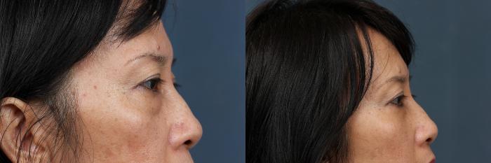 Eyelid Surgery Case 607 Before & After View #3 | Louisville, KY | CaloSpa® Rejuvenation Center