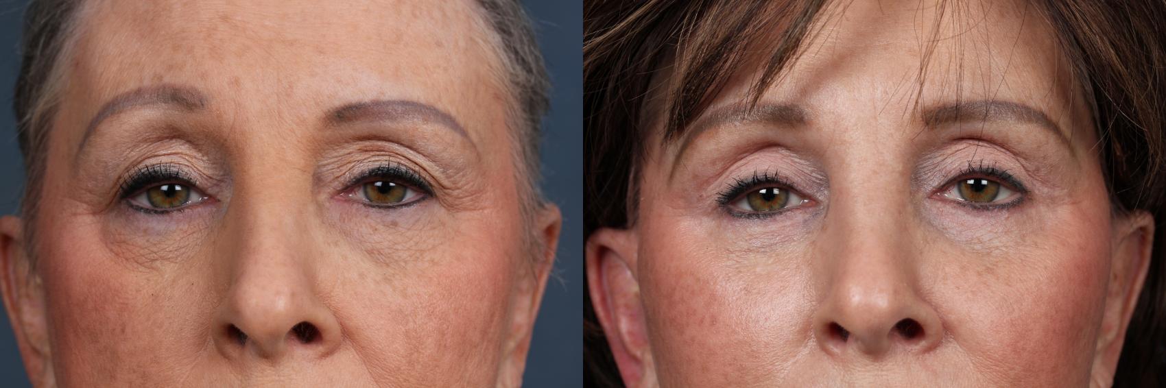 Before & After Eyelid Surgery Case 608 View #1 View in Louisville & Lexington, KY