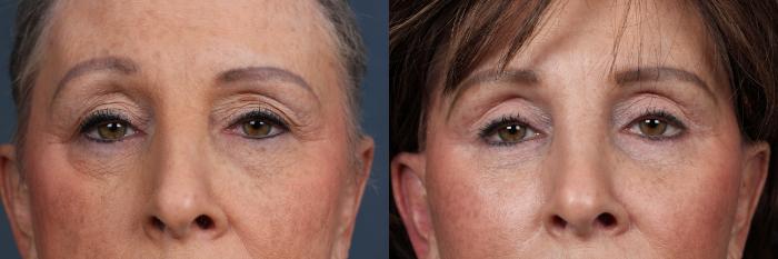 Eyelid Surgery Case 608 Before & After View #1 | Louisville, KY | CaloSpa® Rejuvenation Center