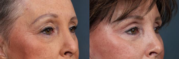 Before & After Eyelid Surgery Case 608 View #2 View in Louisville & Lexington, KY