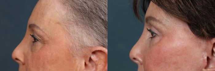 Eyelid Surgery Case 608 Before & After View #3 | Louisville, KY | CaloSpa® Rejuvenation Center