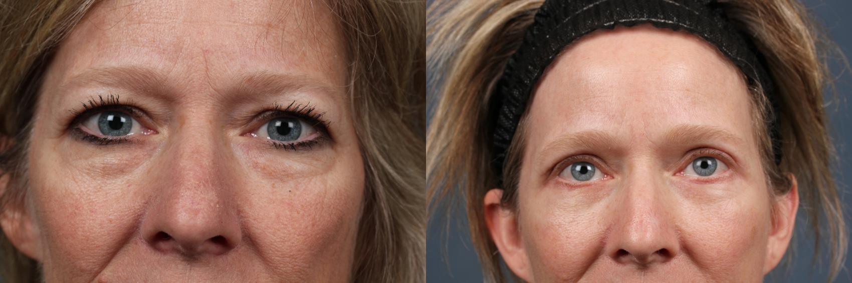 Before & After Eyelid Surgery Case 609 View #1 View in Louisville & Lexington, KY