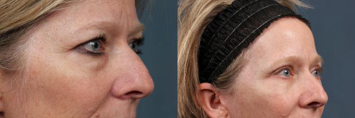 Before & After Eyelid Surgery Case 609 View #2 View in Louisville & Lexington, KY