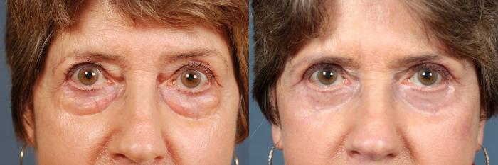 Before & After Eyelid Surgery Case 610 View #1 View in Louisville & Lexington, KY