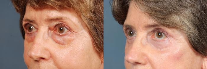 Eyelid Surgery Case 610 Before & After View #2 | Louisville, KY | CaloSpa® Rejuvenation Center