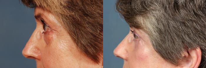 Before & After Eyelid Surgery Case 610 View #3 View in Louisville & Lexington, KY