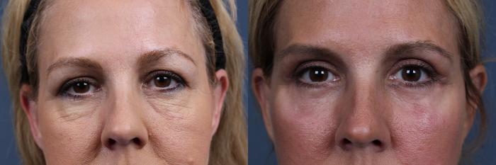 Before & After Eyelid Surgery Case 611 View #1 View in Louisville & Lexington, KY