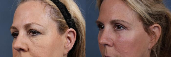 Eyelid Surgery Case 611 Before & After View #2 | Louisville, KY | CaloSpa® Rejuvenation Center