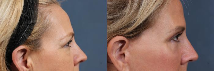 Before & After Eyelid Surgery Case 611 View #3 View in Louisville & Lexington, KY