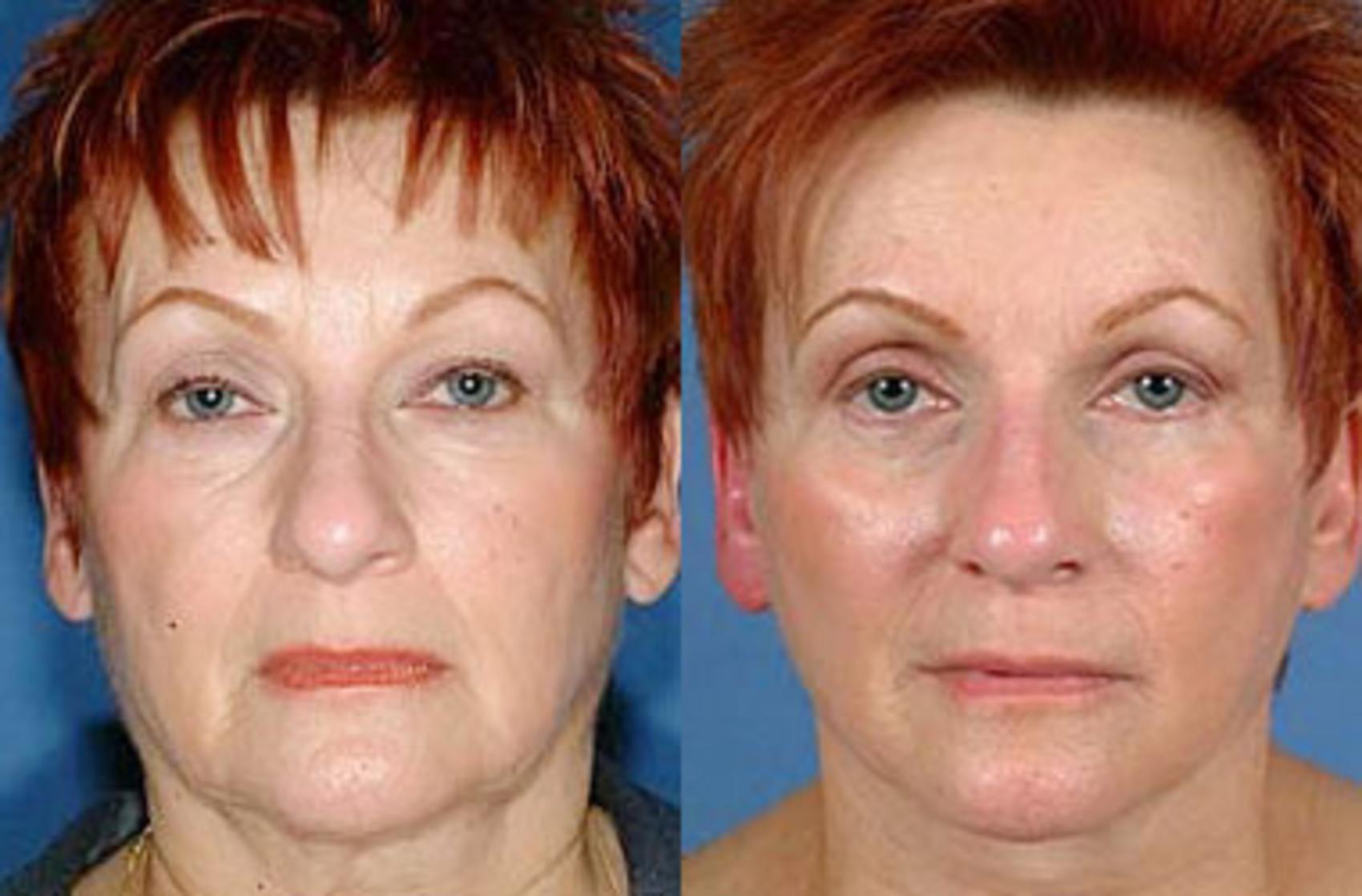 Eyelid Surgery Case 65 Before & After View #1 | Louisville, KY | CaloSpa® Rejuvenation Center
