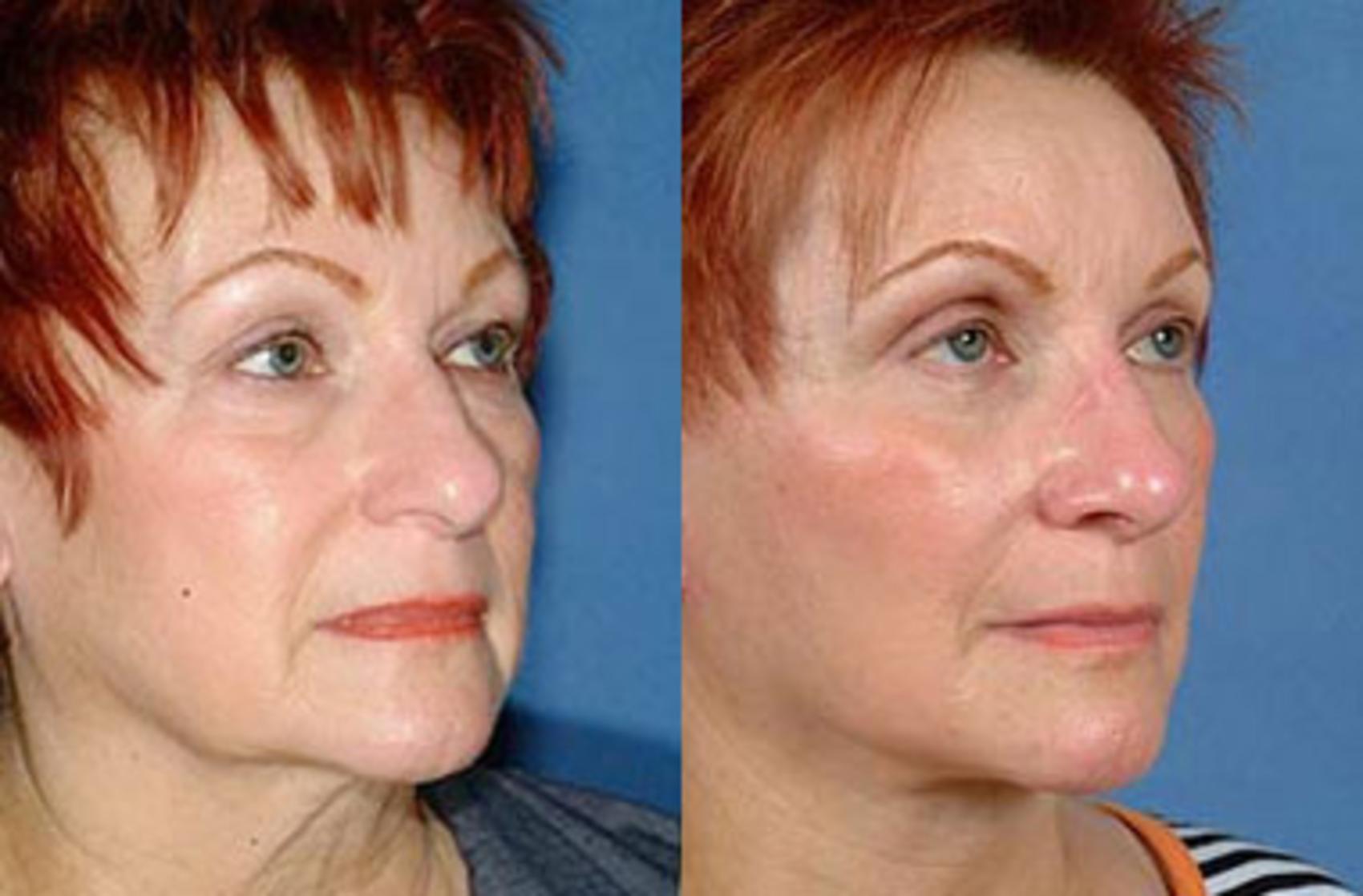 Eyelid Surgery Before And After Photos Patient 65 Louisville Ky Calospa® Rejuvenation Center 