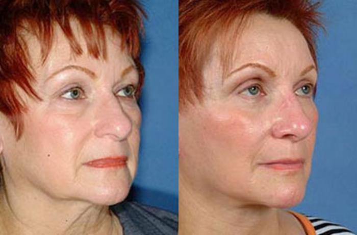 Before & After Eyelid Surgery Case 65 View #2 View in Louisville & Lexington, KY