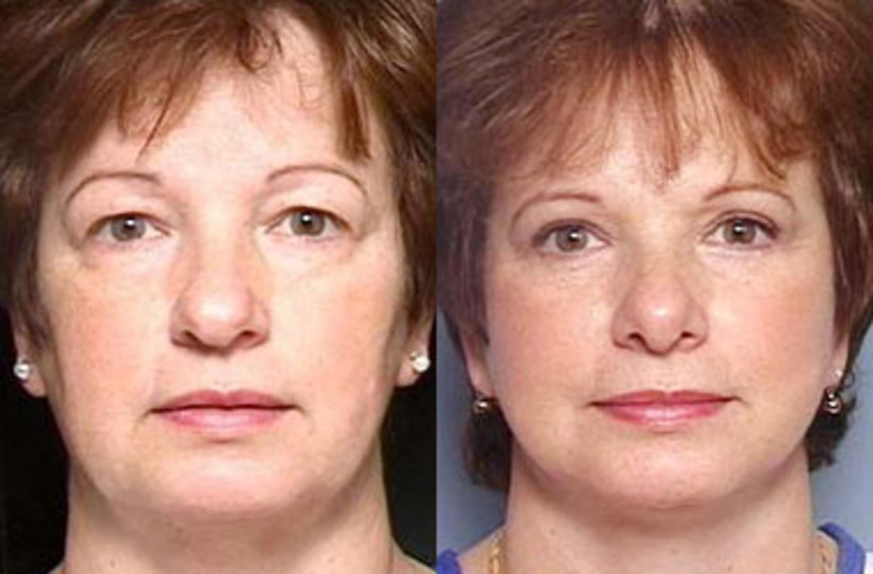Before & After Eyelid Surgery Case 66 View #1 View in Louisville & Lexington, KY