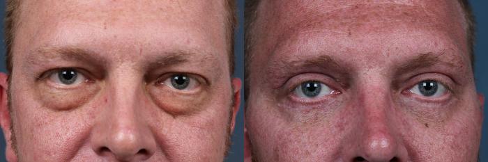 Before & After Eyelid Surgery Case 717 Front View in Louisville & Lexington, KY