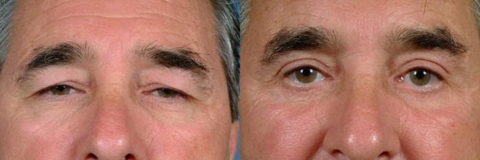 Before & After Eyelid Surgery Case 720 Front View in Louisville & Lexington, KY