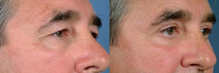 Before & After Eyelid Surgery Case 720 Left Oblique View in Louisville & Lexington, KY