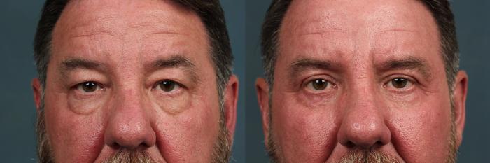 Before & After Eyelid Surgery Case 728 Front View in Louisville & Lexington, KY