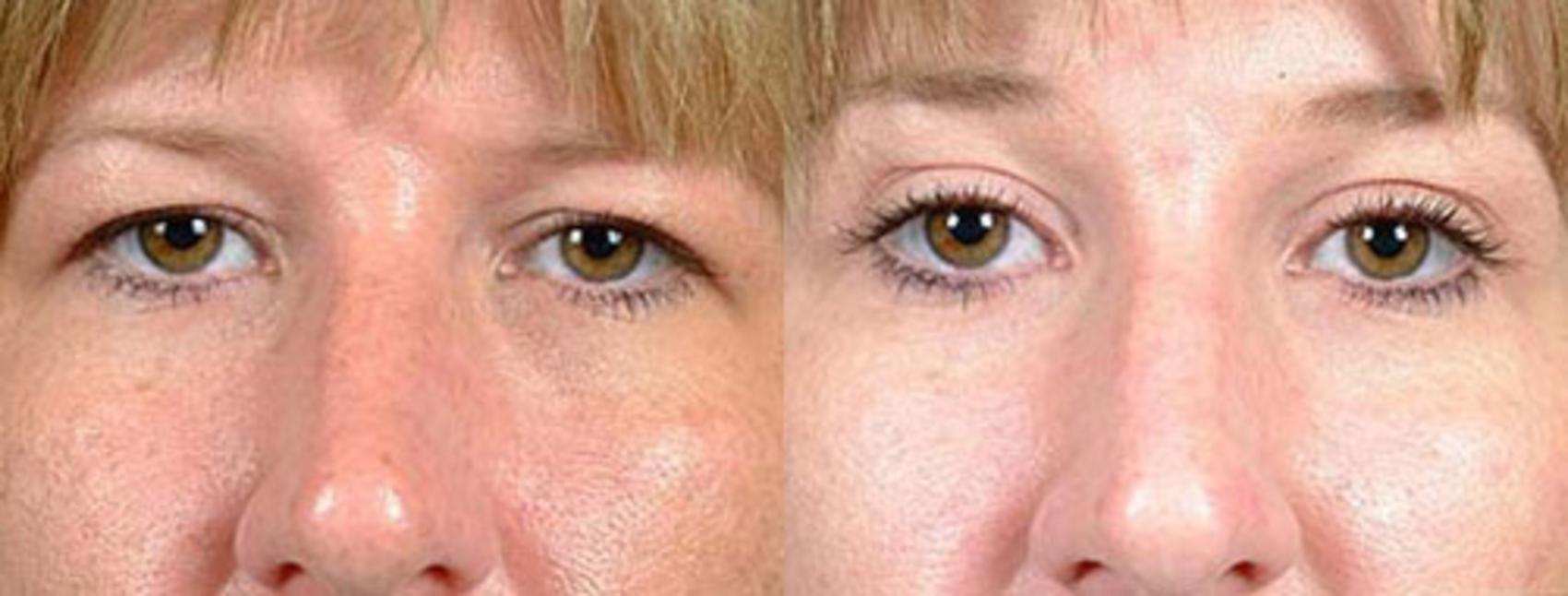 Before & After Eyelid Surgery Case 76 View #1 View in Louisville & Lexington, KY