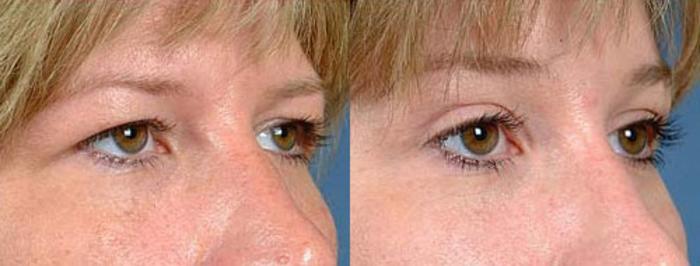 Eyelid Surgery Case 76 Before & After View #2 | Louisville, KY | CaloSpa® Rejuvenation Center