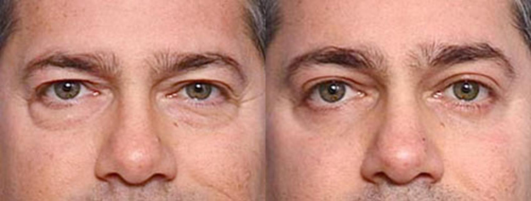 Before & After Eyelid Surgery Case 80 View #1 View in Louisville, KY