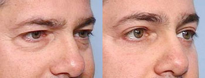 Before & After Eyelid Surgery Case 80 View #2 View in Louisville & Lexington, KY