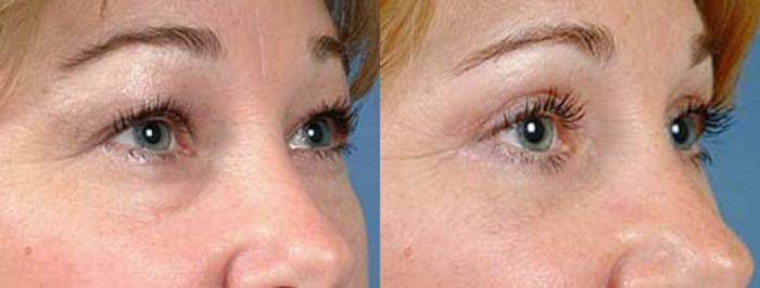 Eyelid Surgery Case 81 Before & After View #2 | Louisville, KY | CaloSpa® Rejuvenation Center