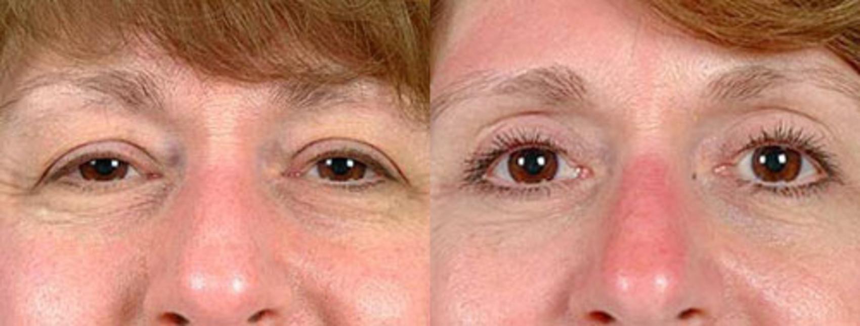 Before & After Eyelid Surgery Case 82 View #1 View in Louisville & Lexington, KY