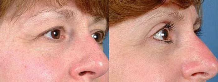 Before & After Eyelid Surgery Case 82 View #2 View in Louisville & Lexington, KY