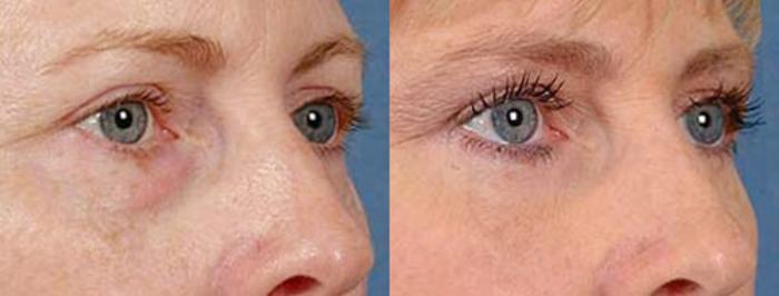 Eyelid Surgery Case 83 Before & After View #2 | Louisville, KY | CaloSpa® Rejuvenation Center