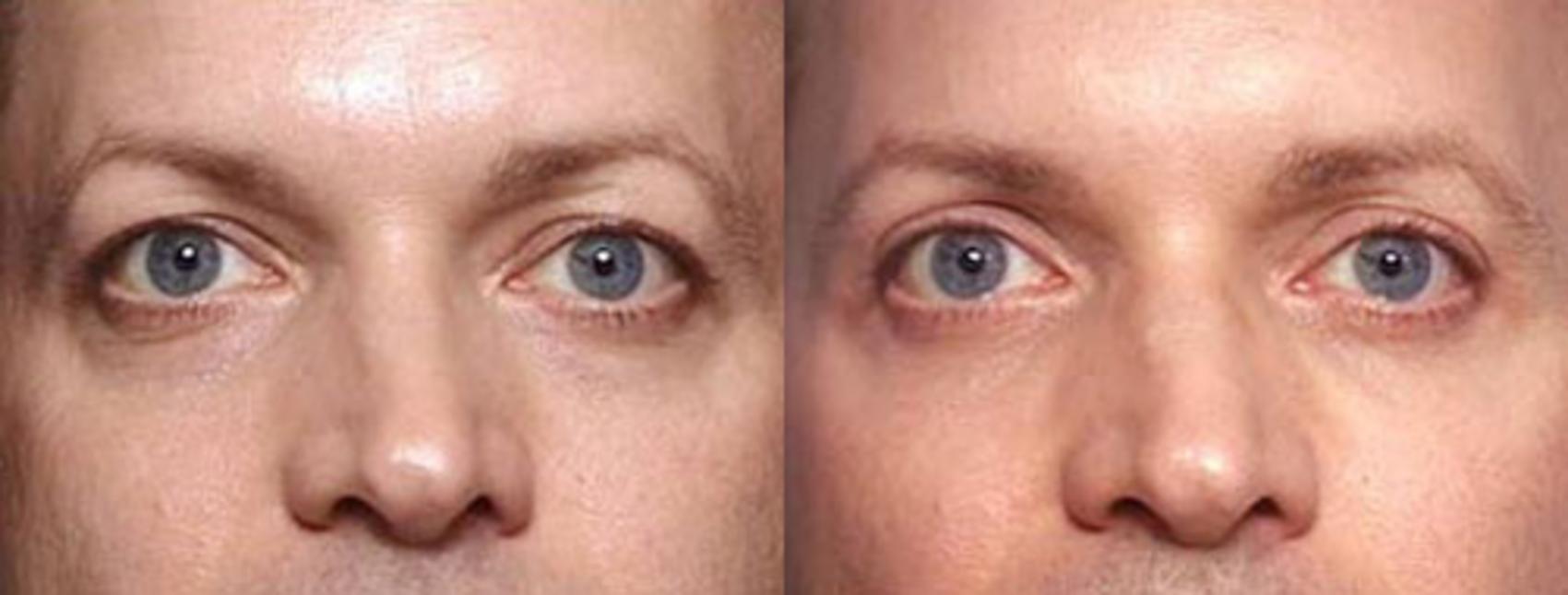 Eyelid Surgery Case 84 Before & After View #1 | Louisville, KY | CaloSpa® Rejuvenation Center