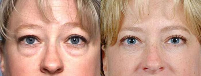 Before & After Eyelid Surgery Case 85 View #1 View in Louisville & Lexington, KY