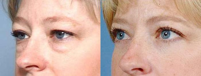 Before & After Eyelid Surgery Case 85 View #2 View in Louisville & Lexington, KY