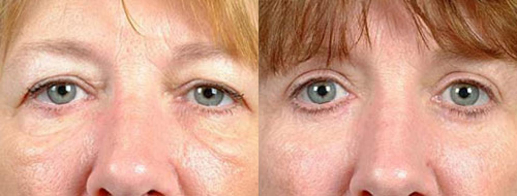 Before & After Eyelid Surgery Case 86 View #1 View in Louisville & Lexington, KY