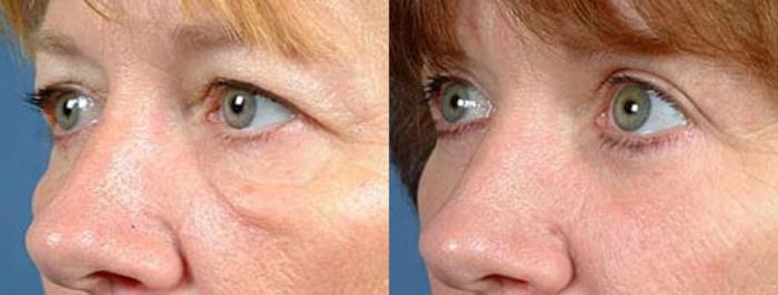 Before & After Eyelid Surgery Case 86 View #2 View in Louisville & Lexington, KY
