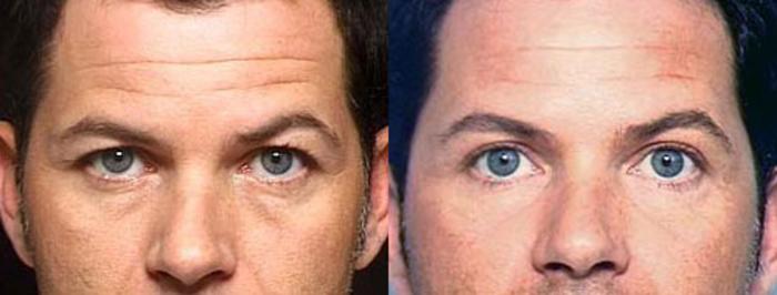Before & After Eyelid Surgery Case 87 View #1 View in Louisville & Lexington, KY