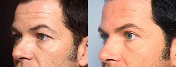 Before & After Eyelid Surgery Case 87 View #2 View in Louisville & Lexington, KY