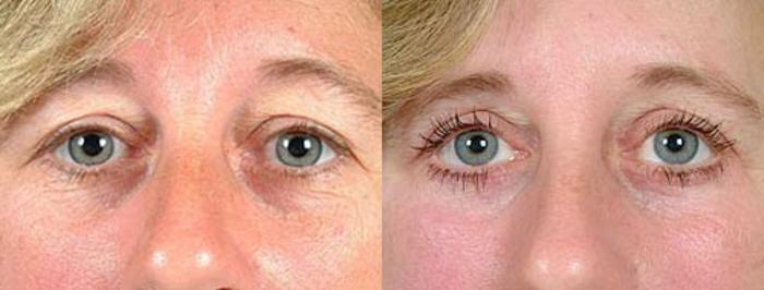 Eyelid Surgery Case 88 Before & After View #1 | Louisville, KY | CaloSpa® Rejuvenation Center