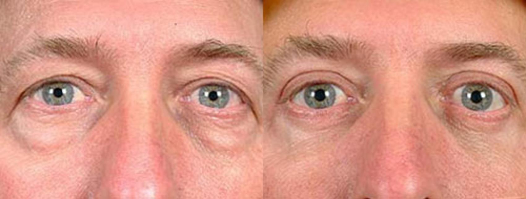Eyelid Surgery Case 89 Before & After View #1 | Louisville, KY | CaloSpa® Rejuvenation Center
